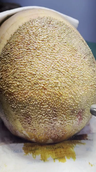 Royal Hair Transplantation